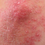 vitamin-derivative-pantethine-alleviates-psoriasis-symptoms-in-small-human-trial